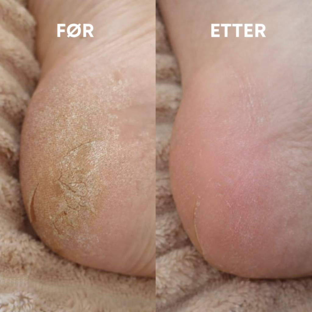 Glass Fotfil - Myke føtter på sekunder